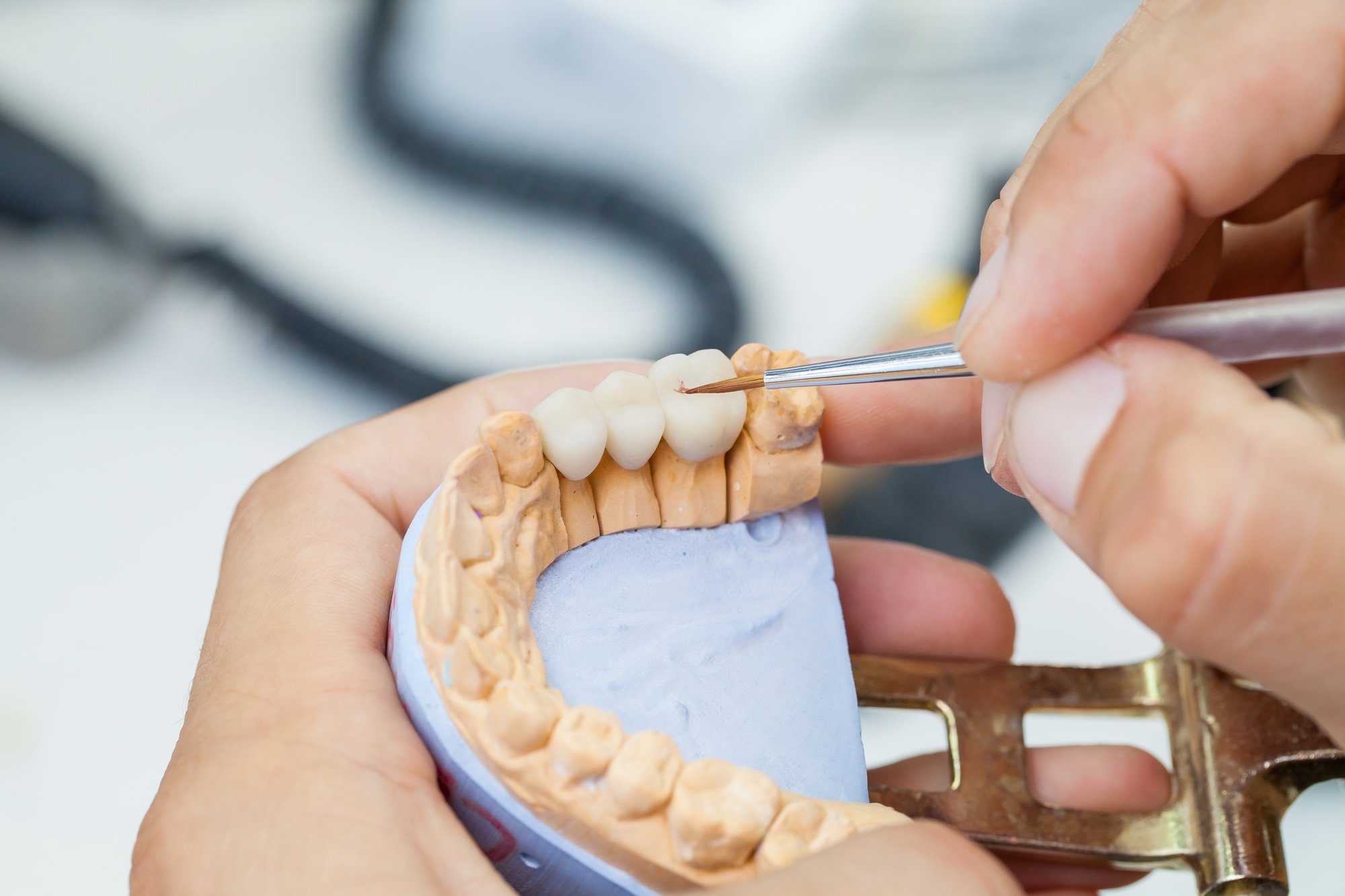 Restorative Dentistry at The Smile Spa in Agoura Hills, CA — When Do Dentists Choose an Inlay Over a Filling?